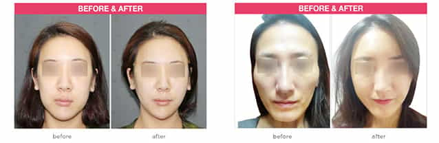 Anti Aging, Face Lift, Seoul, South Korea